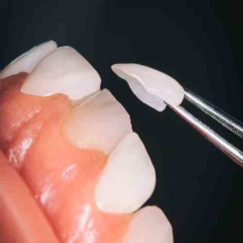 مرکز تخصصی لمینت دندان زعفرانیه