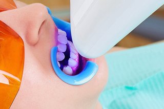 عوارض و ضرر بلیچینگ دندان