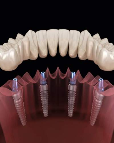 انواع ایمپلنت دندان در زعفرانیه و ولنجک