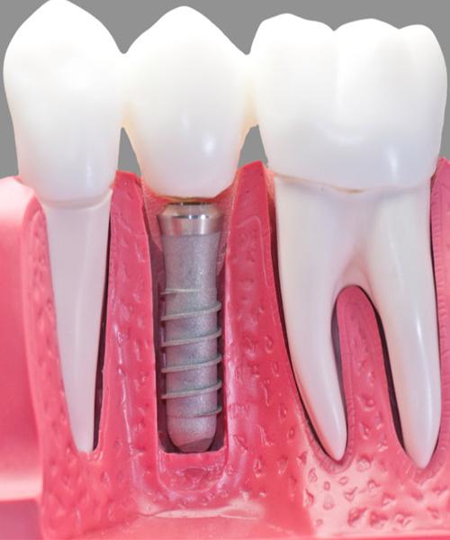 انواع دندان مصنوعی و پروتز دندان