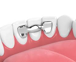 بریج دندان همان پل دندان است