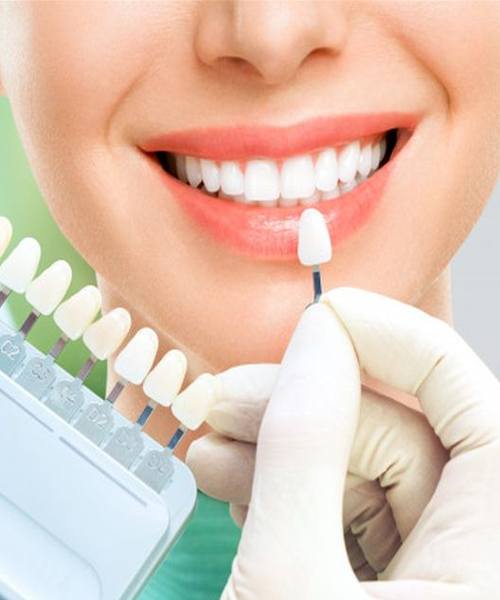 مراقبت بعد از کامپوزیت دندان