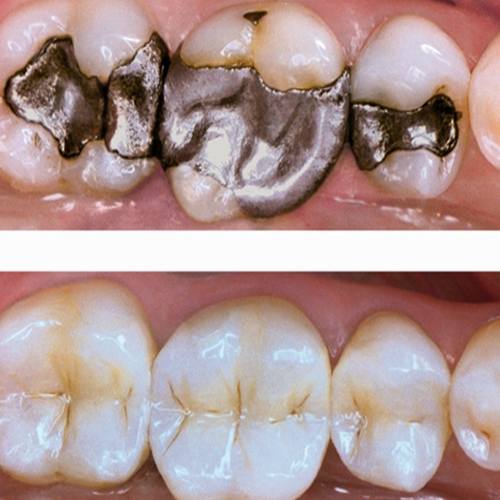 مراقبت پس از کامپوزیت دندان