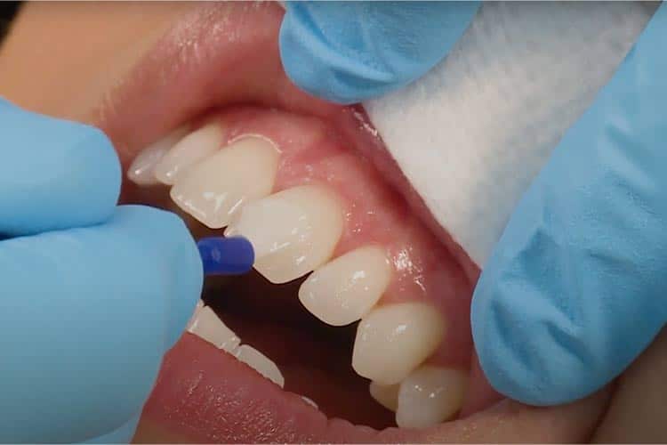 فلوراید تراپی چیست و تفاوت آن با فلوراید دندان