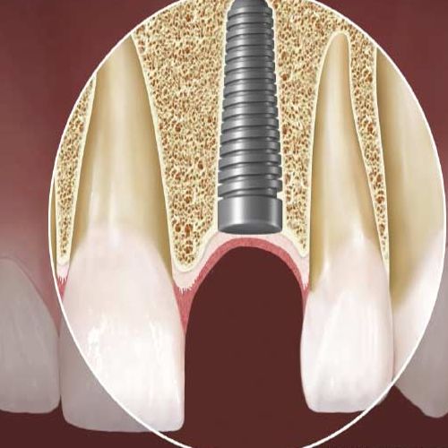 کاشت ایمپلنت دندان در افراد مبتلا به دیابت